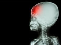 Traumatic Brain Injuries